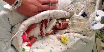 Rođena u 23. tjednu, moja beba pokazuje da su i najmanja bića sposobna za život i dostojna spašavanja