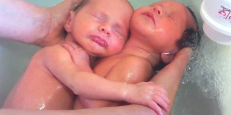 Čudo života - Nakon poroda ovi blizanci još uvijek su zagrljeni