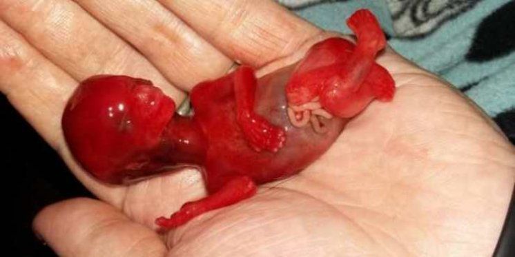 Nevjerovatna fotografija djeteta koje je pobačeno u 14. tjednu trudnoće otkriva čovještvo nerođene djece